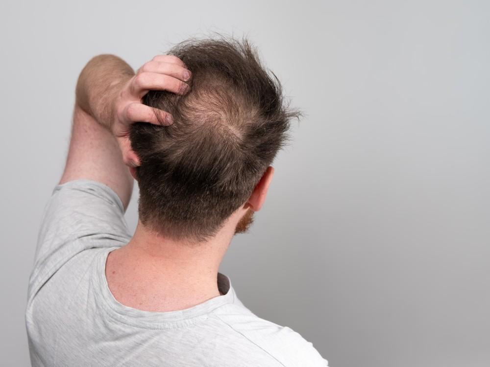 Modafinil and Hair Loss